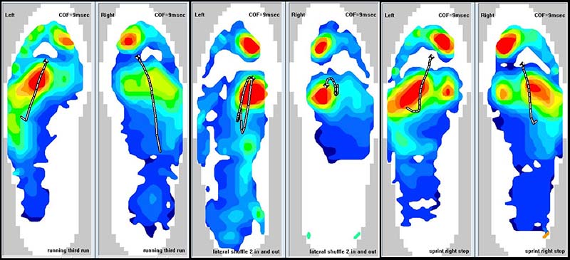 Plantar Pressure Map