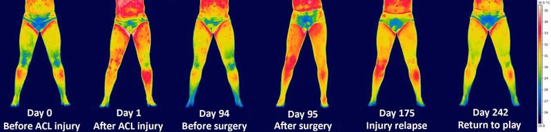 Thermogram of ACL Injury