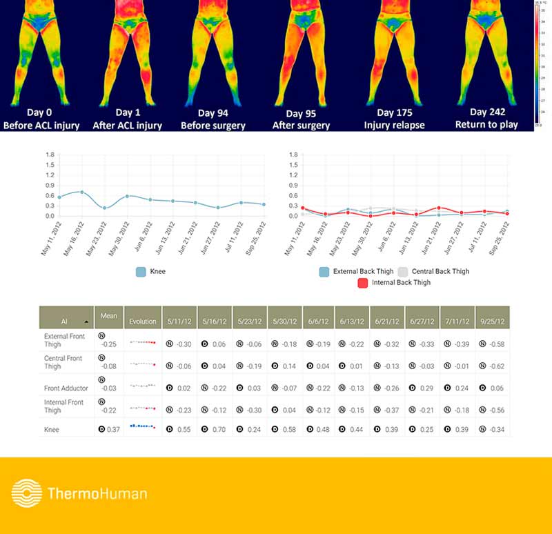 ThermoHuman ACL