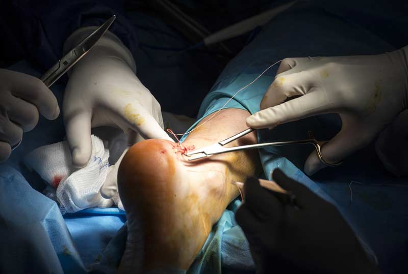 Achilles Surgery