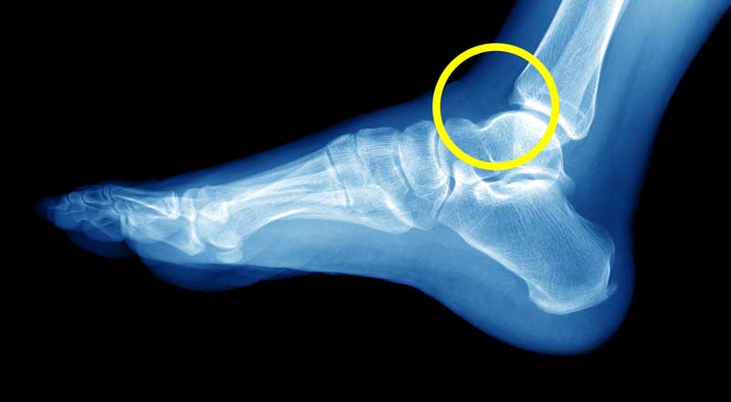 Ankle X-Ray