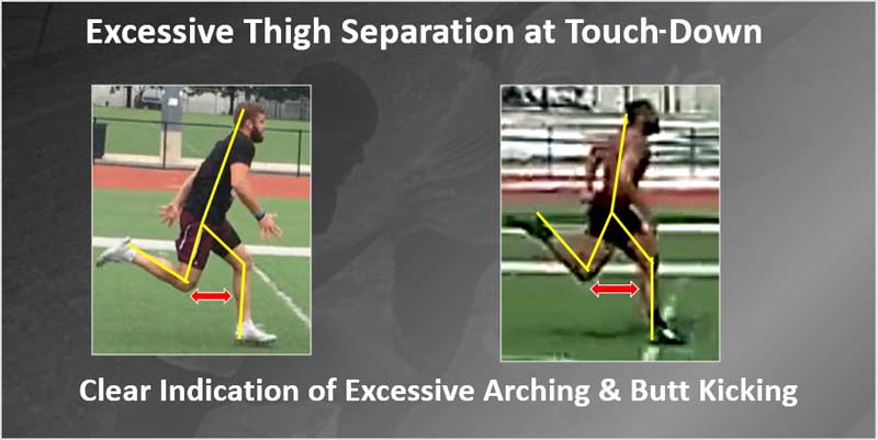 Excessive Thigh Separation