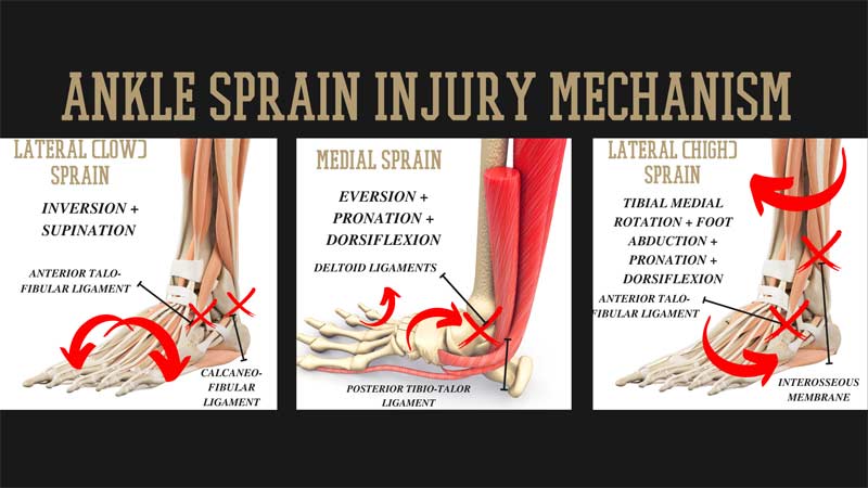Ankle Sprain Mechanism