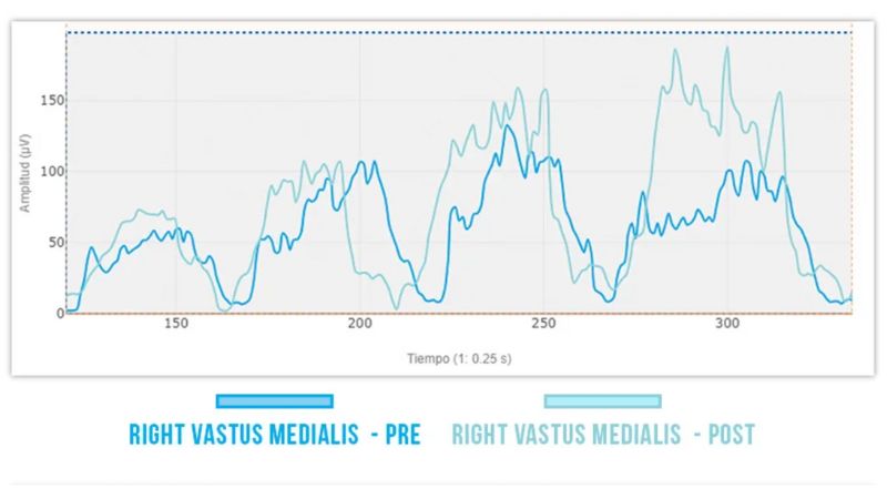 Line graph comparing right vastus medialis muscle amplitude before (darker blue) and after (lighter blue) an intervention over time in seconds, showing higher amplitudes post-intervention.