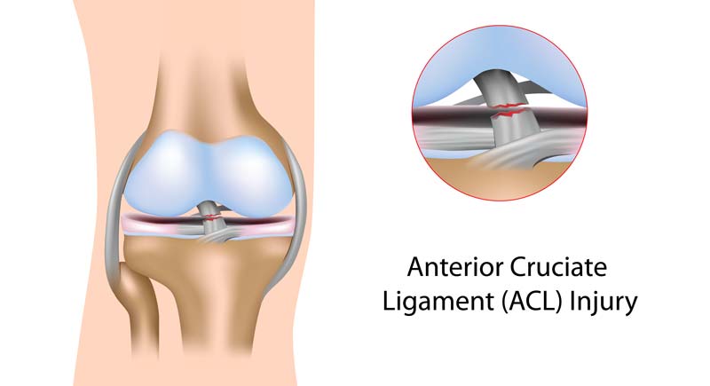 ACL Diagram