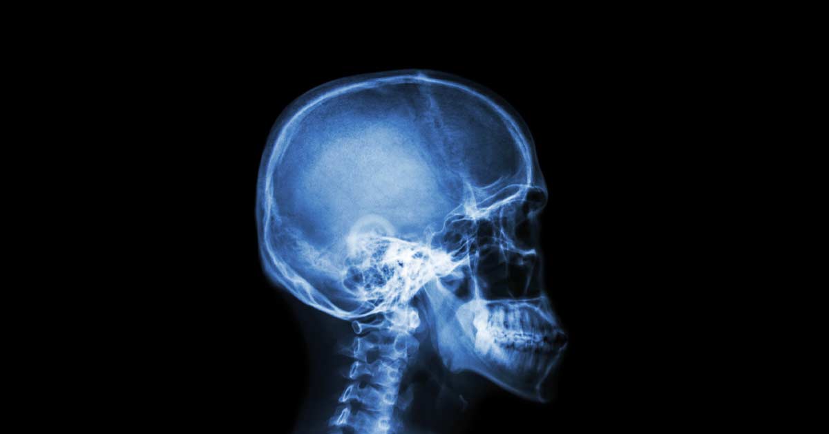 Concussion X-Ray