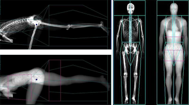 DXA Body Scan