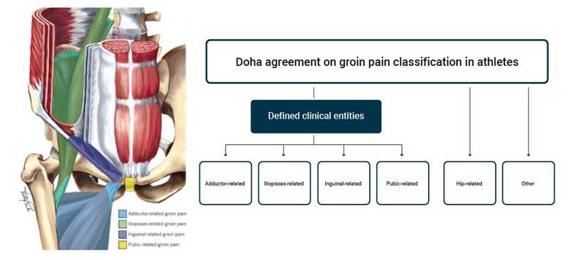 Doha Groin Pain