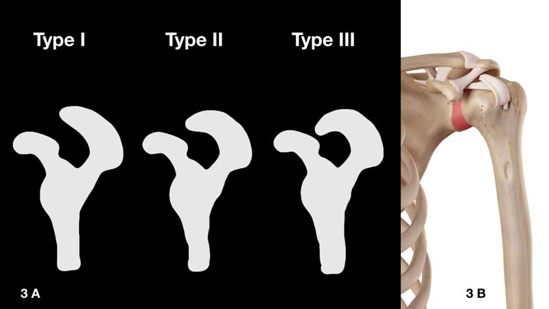 Acromion