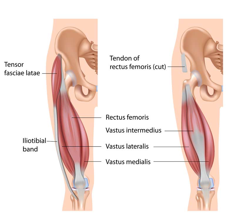Quadriceps Muscle