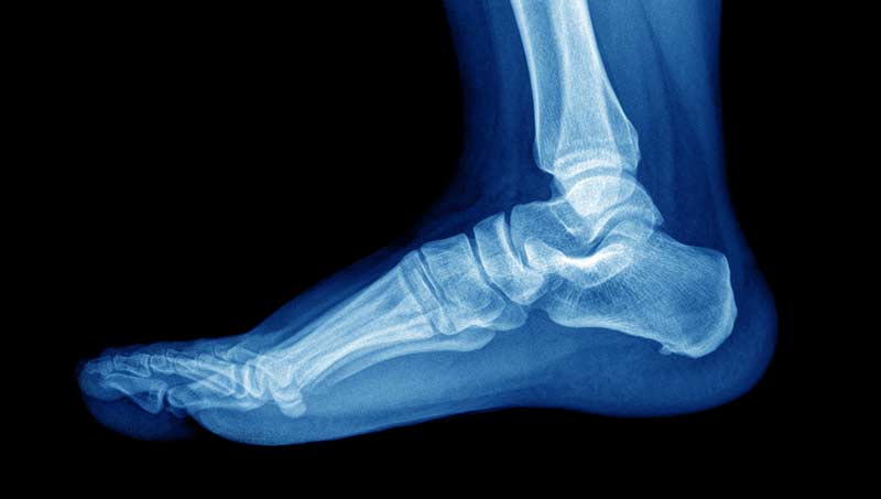 Foot X-Ray