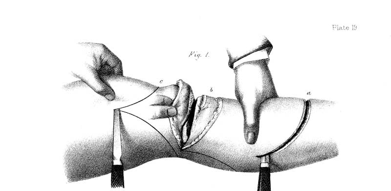 Knee Surgery