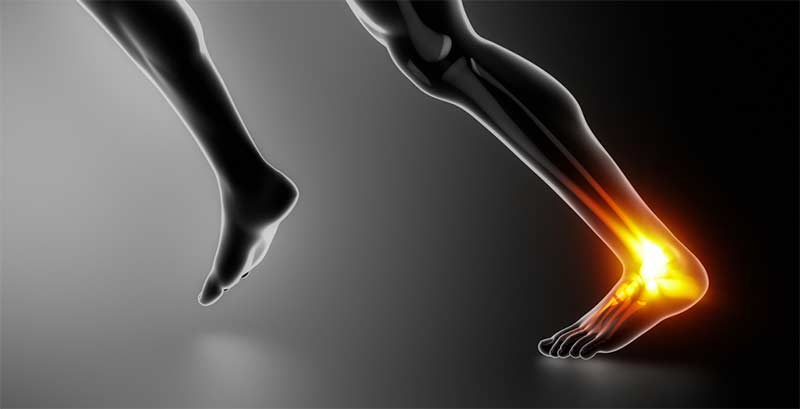 Running Injuries