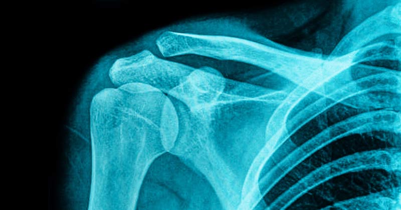 Shoulder MRI