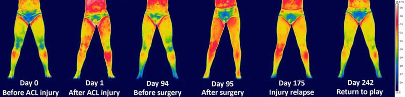 Thermogram of ACL Injury