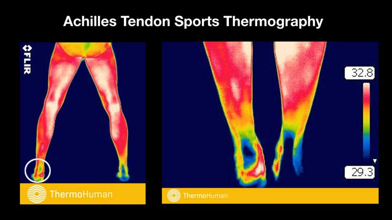 Thermohuman Achilles Tendon