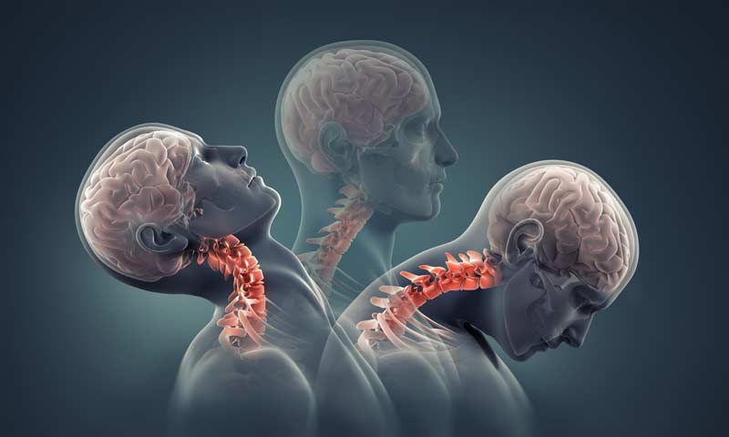 Whiplash Injury