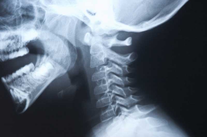 Xray Image of Disk Degeneration|The Descartes Reflex|Disk and Fascia Degeneration
